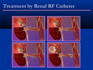 Treatment by Renal RF Catheter
 