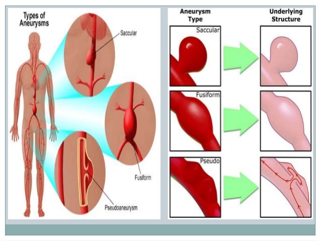 types of aneurysms