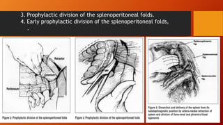 3. Prophylactic division of the splenoperitoneal folds.
4. Early prophylactic division of the splenoperitoneal folds,
.
 