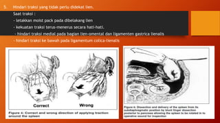 5. Hindari traksi yang tidak perlu didekat lien.
Saat traksi :
- letakkan moist pack pada dibelakang lien
- kekuatan traksi terus-menerus secara hati-hati.
- hindari traksi medial pada bagian lien-omental dan ligamenten gastrica lienalis
- hindari traksi ke bawah pada ligamentum colica-lienalis
 