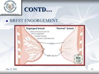 CONTD…
 BREST ENGORGEMENT
May 22, 2020 10
 