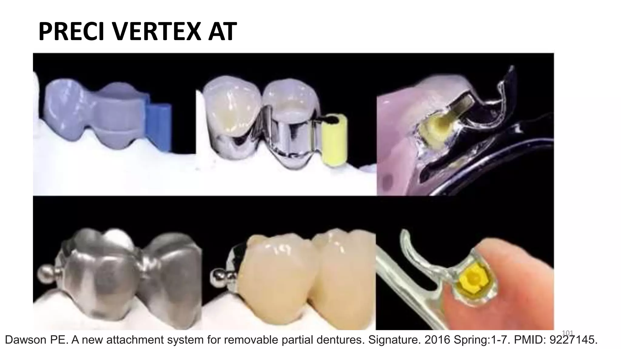 PRECI VERTEX AT
Dawson PE. A new attachment system for removable partial dentures. Signature. 2016 Spring:1-7. PMID: 9227145.
101
 