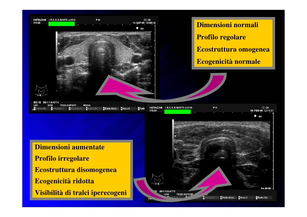Differenza Tra Ecografia Tiroidea E Ecocolordoppler Tiroideo Aliotta A. Ecografia della tiroide