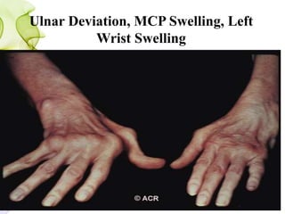 Ulnar Deviation, MCP Swelling, Left
Wrist Swelling
 