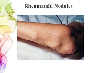 Rheumatoid Nodules
 