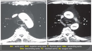 AA : aortic arch. SVC: superior vena cava. T: thymus gland. AAo : ascending aorta.
DAo: descending aorta. TC: tracheal carina. Az: azygos vein
 