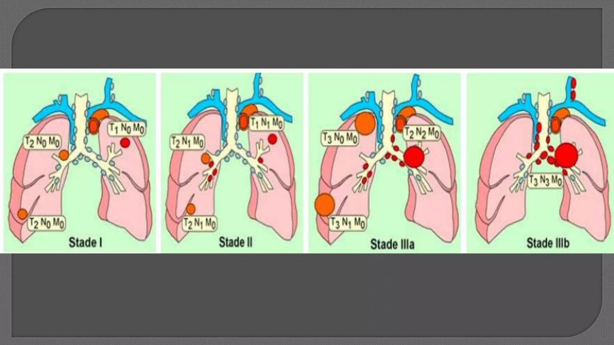 Surgical Management for Non Small Cell Lung Cancer | PPTX