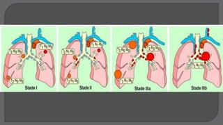 Surgical Management for Non Small Cell Lung Cancer | PPTX