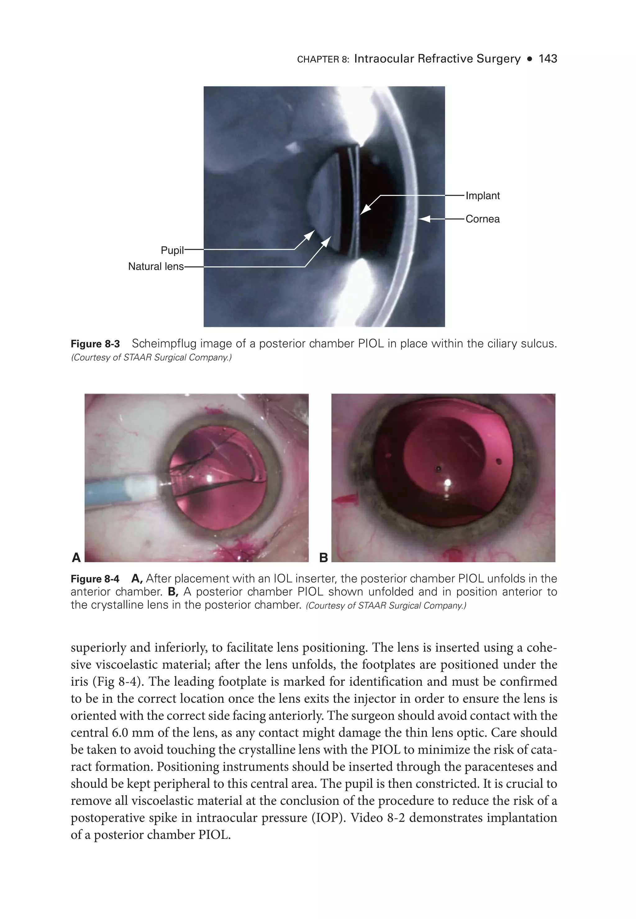 Chapter 8:  Intraocular Refractive Surgery  ● 143
superiorly and inferiorly, to facilitate lens positioning. The lens is inserted using a cohe-
sive viscoelastic material; after the lens unfolds, the footplates are positioned under the
iris (Fig 8-4). The leading footplate is marked for identification and must be confirmed
to be in the correct location once the lens exits the injector in order to ensure the lens is
oriented with the correct side facing anteriorly. The surgeon should avoid contact with the
central 6.0 mm of the lens, as any contact might damage the thin lens optic. Care should
be taken to avoid touching the crystalline lens with the PIOL to minimize the risk of cata-
ract formation. Positioning instruments should be inserted through the paracenteses and
should be kept peripheral to this central area. The pupil is then constricted. It is crucial to
remove all viscoelastic material at the conclusion of the procedure to reduce the risk of a
postoperative spike in intraocular pressure (IOP). Video 8-2 demonstrates implantation
of a posterior chamber PIOL.
Pupil
Natural lens
Implant
Cornea
Figure 8-3  Scheimpflug image of a posterior chamber PIOL in place within the ciliary sulcus.
(Courtesy of STAAR Surgical Company.)
A B
Figure 8-4  A, After placement with an IOL inserter, the posterior chamber PIOL unfolds in the
anterior chamber. B, A posterior chamber PIOL shown unfolded and in position anterior to
the crystalline lens in the posterior chamber. (Courtesy of STAAR Surgical Company.)
 