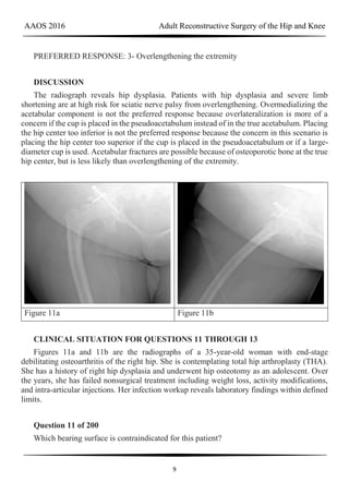 AAOS 2016 Adult Reconstructive Surgery of the Hip and Knee
9
PREFERRED RESPONSE: 3- Overlengthening the extremity
DISCUSSION
The radiograph reveals hip dysplasia. Patients with hip dysplasia and severe limb
shortening are at high risk for sciatic nerve palsy from overlengthening. Overmedializing the
acetabular component is not the preferred response because overlateralization is more of a
concern if the cup is placed in the pseudoacetabulum instead of in the true acetabulum. Placing
the hip center too inferior is not the preferred response because the concern in this scenario is
placing the hip center too superior if the cup is placed in the pseudoacetabulum or if a large-
diameter cup is used. Acetabular fractures are possible because of osteoporotic bone at the true
hip center, but is less likely than overlengthening of the extremity.
Figure 11a Figure 11b
CLINICAL SITUATION FOR QUESTIONS 11 THROUGH 13
Figures 11a and 11b are the radiographs of a 35-year-old woman with end-stage
debilitating osteoarthritis of the right hip. She is contemplating total hip arthroplasty (THA).
She has a history of right hip dysplasia and underwent hip osteotomy as an adolescent. Over
the years, she has failed nonsurgical treatment including weight loss, activity modifications,
and intra-articular injections. Her infection workup reveals laboratory findings within defined
limits.
Question 11 of 200
Which bearing surface is contraindicated for this patient?
 