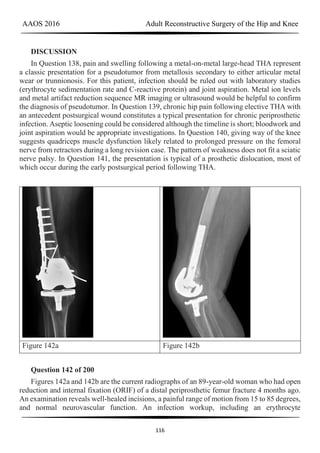 AAOS 2016 Adult Reconstructive Surgery of the Hip and Knee
116
DISCUSSION
In Question 138, pain and swelling following a metal-on-metal large-head THA represent
a classic presentation for a pseudotumor from metallosis secondary to either articular metal
wear or trunnionosis. For this patient, infection should be ruled out with laboratory studies
(erythrocyte sedimentation rate and C-reactive protein) and joint aspiration. Metal ion levels
and metal artifact reduction sequence MR imaging or ultrasound would be helpful to confirm
the diagnosis of pseudotumor. In Question 139, chronic hip pain following elective THA with
an antecedent postsurgical wound constitutes a typical presentation for chronic periprosthetic
infection. Aseptic loosening could be considered although the timeline is short; bloodwork and
joint aspiration would be appropriate investigations. In Question 140, giving way of the knee
suggests quadriceps muscle dysfunction likely related to prolonged pressure on the femoral
nerve from retractors during a long revision case. The pattern of weakness does not fit a sciatic
nerve palsy. In Question 141, the presentation is typical of a prosthetic dislocation, most of
which occur during the early postsurgical period following THA.
Figure 142a Figure 142b
Question 142 of 200
Figures 142a and 142b are the current radiographs of an 89-year-old woman who had open
reduction and internal fixation (ORIF) of a distal periprosthetic femur fracture 4 months ago.
An examination reveals well-healed incisions, a painful range of motion from 15 to 85 degrees,
and normal neurovascular function. An infection workup, including an erythrocyte
 