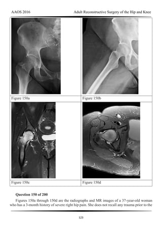 AAOS 2016 Adult Reconstructive Surgery of the Hip and Knee
123
Figure 150a Figure 150b
Figure 150c Figure 150d
Question 150 of 200
Figures 150a through 150d are the radiographs and MR images of a 37-year-old woman
who has a 3-month history of severe right hip pain. She does not recall any trauma prior to the
 
