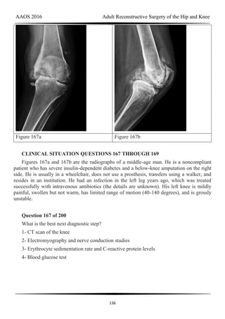 AAOS 2016 Adult Reconstructive Surgery of the Hip and Knee
136
Figure 167a Figure 167b
CLINICAL SITUATION QUESTIONS 167 THROUGH 169
Figures 167a and 167b are the radiographs of a middle-age man. He is a noncompliant
patient who has severe insulin-dependent diabetes and a below-knee amputation on the right
side. He is usually in a wheelchair, does not use a prosthesis, transfers using a walker, and
resides in an institution. He had an infection in the left leg years ago, which was treated
successfully with intravenous antibiotics (the details are unknown). His left knee is mildly
painful, swollen but not warm, has limited range of motion (40-140 degrees), and is grossly
unstable.
Question 167 of 200
What is the best next diagnostic step?
1- CT scan of the knee
2- Electromyography and nerve conduction studies
3- Erythrocyte sedimentation rate and C-reactive protein levels
4- Blood glucose test
 