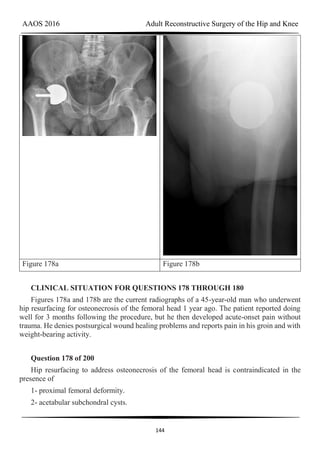 AAOS 2016 Adult Reconstructive Surgery of the Hip and Knee
144
Figure 178a Figure 178b
CLINICAL SITUATION FOR QUESTIONS 178 THROUGH 180
Figures 178a and 178b are the current radiographs of a 45-year-old man who underwent
hip resurfacing for osteonecrosis of the femoral head 1 year ago. The patient reported doing
well for 3 months following the procedure, but he then developed acute-onset pain without
trauma. He denies postsurgical wound healing problems and reports pain in his groin and with
weight-bearing activity.
Question 178 of 200
Hip resurfacing to address osteonecrosis of the femoral head is contraindicated in the
presence of
1- proximal femoral deformity.
2- acetabular subchondral cysts.
 