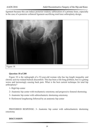 AAOS 2016 Adult Reconstructive Surgery of the Hip and Knee
14
ligament because this can induce posterior rotatory subluxation of a primary knee, especially
in the case of a posterior collateral ligament-sacrificing total knee arthroplasty design.
Figure 18
Question 18 of 200
Figure 18 is the radiograph of a 52-year-old woman who has leg length inequality and
chronic activity-related buttock discomfort. This has been a life-long problem, but it is getting
worse and increasingly causing back pain. What is the best current technique for total hip
arthroplasty?
1- High hip center
2- Anatomic hip center with trochanteric osteotomy and progressive femoral shortening
3- Anatomic hip center with subtrochanteric shortening osteotomy
4- Iliofemoral lengthening followed by an anatomic hip center
PREFERRED RESPONSE: 3- Anatomic hip center with subtrochanteric shortening
osteotomy
DISCUSSION
 