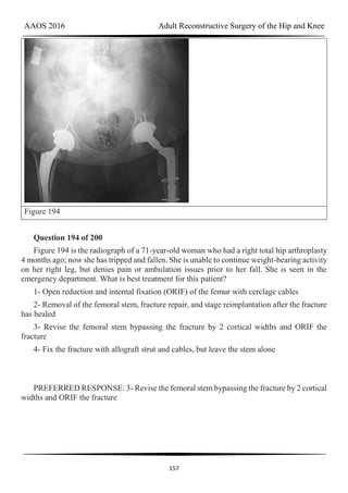 AAOS 2016 Adult Reconstructive Surgery of the Hip and Knee
157
Figure 194
Question 194 of 200
Figure 194 is the radiograph of a 71-year-old woman who had a right total hip arthroplasty
4 months ago; now she has tripped and fallen. She is unable to continue weight-bearing activity
on her right leg, but denies pain or ambulation issues prior to her fall. She is seen in the
emergency department. What is best treatment for this patient?
1- Open reduction and internal fixation (ORIF) of the femur with cerclage cables
2- Removal of the femoral stem, fracture repair, and stage reimplantation after the fracture
has healed
3- Revise the femoral stem bypassing the fracture by 2 cortical widths and ORIF the
fracture
4- Fix the fracture with allograft strut and cables, but leave the stem alone
PREFERRED RESPONSE: 3- Revise the femoral stem bypassing the fracture by 2 cortical
widths and ORIF the fracture
 