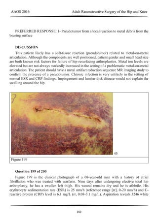 AAOS 2016 Adult Reconstructive Surgery of the Hip and Knee
160
PREFERRED RESPONSE: 1- Pseudotumor from a local reaction to metal debris from the
bearing surface
DISCUSSION
This patient likely has a soft-tissue reaction (pseudotumor) related to metal-on-metal
articulation. Although the components are well positioned, patient gender and small head size
are both known risk factors for failure of hip resurfacing arthroplasties. Metal ion levels are
elevated but are not always markedly increased in the setting of a problematic metal-on-metal
articulation. The patient should have a metal artifact reduction sequence MR imaging study to
confirm the presence of a pseudotumor. Chronic infection is very unlikely in the setting of
normal ESR and CRP findings. Impingement and lumbar disk disease would not explain the
swelling around the hip.
45
Figure 199
Question 199 of 200
Figure 199 is the clinical photograph of a 68-year-old man with a history of atrial
fibrillation who was treated with warfarin. Nine days after undergoing elective total hip
arthroplasty, he has a swollen left thigh. His wound remains dry and he is afebrile. His
erythrocyte sedimentation rate (ESR) is 25 mm/h (reference range [rr], 0-20 mm/h) and C-
reactive protein (CRP) level is 6.1 mg/L (rr, 0.08-3.1 mg/L). Aspiration reveals 3246 white
 