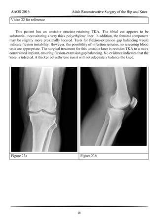 AAOS 2016 Adult Reconstructive Surgery of the Hip and Knee
18
Video 22 for reference
This patient has an unstable cruciate-retaining TKA. The tibial cut appears to be
substantial, necessitating a very thick polyethylene liner. In addition, the femoral component
may be slightly more proximally located. Tests for flexion-extension gap balancing would
indicate flexion instability. However, the possibility of infection remains, so screening blood
tests are appropriate. The surgical treatment for this unstable knee is revision TKA to a more
constrained implant, ensuring flexion-extension gap balancing. No evidence indicates that the
knee is infected. A thicker polyethylene insert will not adequately balance the knee.
Figure 23a Figure 23b
 
