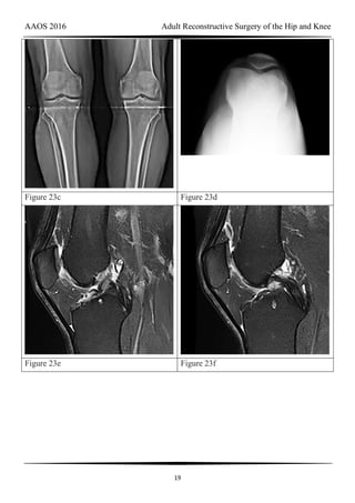 AAOS 2016 Adult Reconstructive Surgery of the Hip and Knee
19
Figure 23c Figure 23d
Figure 23e Figure 23f
 