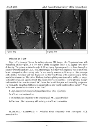 AAOS 2016 Adult Reconstructive Surgery of the Hip and Knee
20
Figure 23g Figure 23h
Question 23 of 200
Figures 23a through 23h are the radiographs and MR images of a 32-year-old man with
worsening left knee pain. A 3-foot hip-to-ankle radiograph shows a 13-degree varus knee
deformity. The patient sustained a major left knee injury 5 years ago and a confirmed complete
anterior cruciate ligament (ACL) tear. He managed this injury nonsurgically with a functional
brace but experienced worsening pain. He was seen by an orthopaedic surgeon 18 months ago
and a medial meniscus tear was diagnosed; the tear was treated with an arthroscopic partial
medial meniscectomy. Since then, his knee has been giving way more often and he no longer
feels safe working on a pitched roof. The patient received 6 months of formal physical therapy
and was fitted for a new functional ACL brace, but he still has pain and instability symptoms.
He believes he has exhausted his nonsurgical options and would like to undergo surgery. What
is the most appropriate treatment at this time?
1- ACL reconstruction and subsequent proximal tibial osteotomy
2- ACL reconstruction alone
3- Distal femoral osteotomy with simultaneous ACL reconstruction
4- Proximal tibial osteotomy with subsequent ACL reconstruction
PREFERRED RESPONSE: 4- Proximal tibial osteotomy with subsequent ACL
reconstruction
 