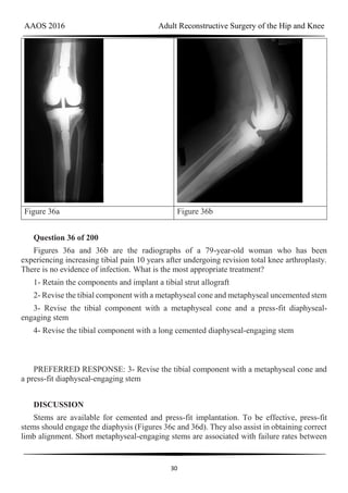 AAOS 2016 Adult Reconstructive Surgery of the Hip and Knee
30
Figure 36a Figure 36b
Question 36 of 200
Figures 36a and 36b are the radiographs of a 79-year-old woman who has been
experiencing increasing tibial pain 10 years after undergoing revision total knee arthroplasty.
There is no evidence of infection. What is the most appropriate treatment?
1- Retain the components and implant a tibial strut allograft
2- Revise the tibial component with a metaphyseal cone and metaphyseal uncemented stem
3- Revise the tibial component with a metaphyseal cone and a press-fit diaphyseal-
engaging stem
4- Revise the tibial component with a long cemented diaphyseal-engaging stem
PREFERRED RESPONSE: 3- Revise the tibial component with a metaphyseal cone and
a press-fit diaphyseal-engaging stem
DISCUSSION
Stems are available for cemented and press-fit implantation. To be effective, press-fit
stems should engage the diaphysis (Figures 36c and 36d). They also assist in obtaining correct
limb alignment. Short metaphyseal-engaging stems are associated with failure rates between
 