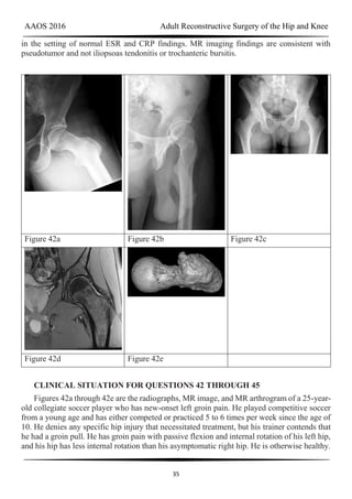 AAOS 2016 Adult Reconstructive Surgery of the Hip and Knee
35
in the setting of normal ESR and CRP findings. MR imaging findings are consistent with
pseudotumor and not iliopsoas tendonitis or trochanteric bursitis.
Figure 42a Figure 42b Figure 42c
Figure 42d Figure 42e
CLINICAL SITUATION FOR QUESTIONS 42 THROUGH 45
Figures 42a through 42e are the radiographs, MR image, and MR arthrogram of a 25-year-
old collegiate soccer player who has new-onset left groin pain. He played competitive soccer
from a young age and has either competed or practiced 5 to 6 times per week since the age of
10. He denies any specific hip injury that necessitated treatment, but his trainer contends that
he had a groin pull. He has groin pain with passive flexion and internal rotation of his left hip,
and his hip has less internal rotation than his asymptomatic right hip. He is otherwise healthy.
 