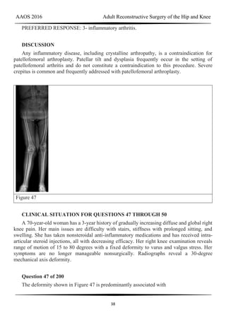 AAOS 2016 Adult Reconstructive Surgery of the Hip and Knee
38
PREFERRED RESPONSE: 3- inflammatory arthritis.
DISCUSSION
Any inflammatory disease, including crystalline arthropathy, is a contraindication for
patellofemoral arthroplasty. Patellar tilt and dysplasia frequently occur in the setting of
patellofemoral arthritis and do not constitute a contraindication to this procedure. Severe
crepitus is common and frequently addressed with patellofemoral arthroplasty.
Figure 47
CLINICAL SITUATION FOR QUESTIONS 47 THROUGH 50
A 70-year-old woman has a 3-year history of gradually increasing diffuse and global right
knee pain. Her main issues are difficulty with stairs, stiffness with prolonged sitting, and
swelling. She has taken nonsteroidal anti-inflammatory medications and has received intra-
articular steroid injections, all with decreasing efficacy. Her right knee examination reveals
range of motion of 15 to 80 degrees with a fixed deformity to varus and valgus stress. Her
symptoms are no longer manageable nonsurgically. Radiographs reveal a 30-degree
mechanical axis deformity.
Question 47 of 200
The deformity shown in Figure 47 is predominantly associated with
 