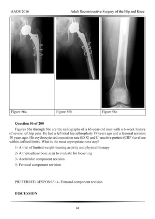 AAOS 2016 Adult Reconstructive Surgery of the Hip and Knee
44
Figure 56a Figure 56b Figure 56c
Question 56 of 200
Figures 56a through 56c are the radiographs of a 65-year-old man with a 6-week history
of severe left hip pain. He had a left total hip arthroplasty 19 years ago and a femoral revision
10 years ago. His erythrocyte sedimentation rate (ESR) and C-reactive protein (CRP) level are
within defined limits. What is the most appropriate next step?
1- A trial of limited weight-bearing activity and physical therapy
2- A triple-phase bone scan to evaluate for loosening
3- Acetabular component revision
4- Femoral component revision
PREFERRED RESPONSE: 4- Femoral component revision
DISCUSSION
 