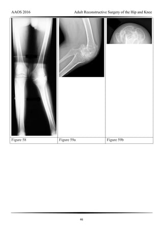 AAOS 2016 Adult Reconstructive Surgery of the Hip and Knee
46
Figure 58 Figure 59a Figure 59b
 