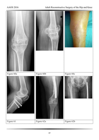 AAOS 2016 Adult Reconstructive Surgery of the Hip and Knee
47
Figure 60a Figure 60b Figure 60c
Figure 61 Figure 62a Figure 62b
 