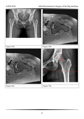 AAOS 2016 Adult Reconstructive Surgery of the Hip and Knee
55
Figure 69a Figure 69b
Figure 69c Figure 70a
 