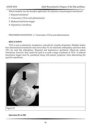 AAOS 2016 Adult Reconstructive Surgery of the Hip and Knee
68
Which modality has the broadest application for reduction of postsurgical transfusion?
1- Regional anesthesia
2- Tranexamic (TXA) acid administration
3- Reduced transfusion trigger
4- Hypotensive anesthesia
PREFERRED RESPONSE: 2- Tranexamic (TXA) acid administration
DISCUSSION
TXA is easy to administer, inexpensive, and safe for virtually all patients. Multiple studies
have demonstrated transfusion rates lower than 3% for total knee arthroplasty and lower than
10% for total hip arthroplasty. Regional and hypotensive anesthesia effectively reduce
transfusion; however, they cannot be used in as wide a range of patients as TXA. A reduced
transfusion trigger must be considered along with patient symptoms when determining the
need for transfusion.
Figure 82
Question 82 of 200
 