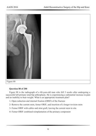 AAOS 2016 Adult Reconstructive Surgery of the Hip and Knee
72
Figure 88
Question 88 of 200
Figure 88 is the radiograph of a 68-year-old man who fell 3 weeks after undergoing a
successful left primary total hip arthroplasty. He is experiencing a substantial increase in pain
and an inability to bear weight. What is an appropriate treatment plan?
1- Open reduction and internal fixation (ORIF) of the fracture
2- Remove the current stem, femur ORIF, and insertion of a longer revision stem
3- Femur ORIF with cables and strut graft, leaving the current stem in situ
4- Femur ORIF combined reimplantation of the primary component
 