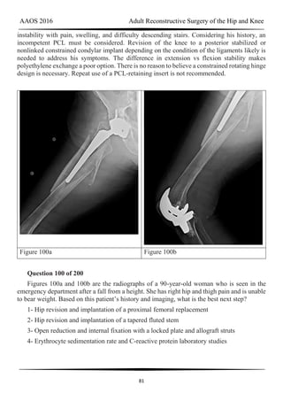 AAOS 2016 Adult Reconstructive Surgery of the Hip and Knee
81
instability with pain, swelling, and difficulty descending stairs. Considering his history, an
incompetent PCL must be considered. Revision of the knee to a posterior stabilized or
nonlinked constrained condylar implant depending on the condition of the ligaments likely is
needed to address his symptoms. The difference in extension vs flexion stability makes
polyethylene exchange a poor option. There is no reason to believe a constrained rotating hinge
design is necessary. Repeat use of a PCL-retaining insert is not recommended.
Figure 100a Figure 100b
Question 100 of 200
Figures 100a and 100b are the radiographs of a 90-year-old woman who is seen in the
emergency department after a fall from a height. She has right hip and thigh pain and is unable
to bear weight. Based on this patient’s history and imaging, what is the best next step?
1- Hip revision and implantation of a proximal femoral replacement
2- Hip revision and implantation of a tapered fluted stem
3- Open reduction and internal fixation with a locked plate and allograft struts
4- Erythrocyte sedimentation rate and C-reactive protein laboratory studies
 