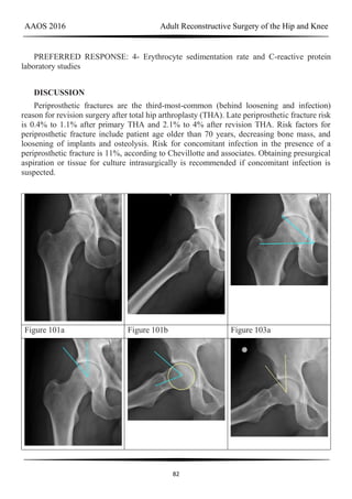 AAOS 2016 Adult Reconstructive Surgery of the Hip and Knee
82
PREFERRED RESPONSE: 4- Erythrocyte sedimentation rate and C-reactive protein
laboratory studies
DISCUSSION
Periprosthetic fractures are the third-most-common (behind loosening and infection)
reason for revision surgery after total hip arthroplasty (THA). Late periprosthetic fracture risk
is 0.4% to 1.1% after primary THA and 2.1% to 4% after revision THA. Risk factors for
periprosthetic fracture include patient age older than 70 years, decreasing bone mass, and
loosening of implants and osteolysis. Risk for concomitant infection in the presence of a
periprosthetic fracture is 11%, according to Chevillotte and associates. Obtaining presurgical
aspiration or tissue for culture intrasurgically is recommended if concomitant infection is
suspected.
Figure 101a Figure 101b Figure 103a
 