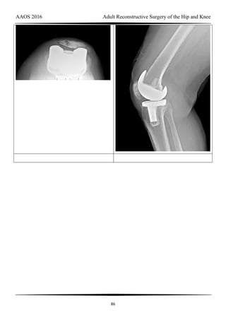 AAOS 2016 Adult Reconstructive Surgery of the Hip and Knee
86
 