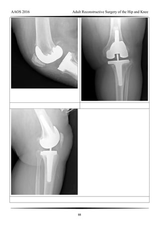 AAOS 2016 Adult Reconstructive Surgery of the Hip and Knee
88
 