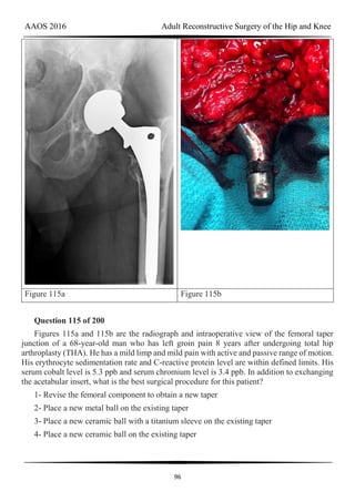AAOS 2016 Adult Reconstructive Surgery of the Hip and Knee
96
Figure 115a Figure 115b
Question 115 of 200
Figures 115a and 115b are the radiograph and intraoperative view of the femoral taper
junction of a 68-year-old man who has left groin pain 8 years after undergoing total hip
arthroplasty (THA). He has a mild limp and mild pain with active and passive range of motion.
His erythrocyte sedimentation rate and C-reactive protein level are within defined limits. His
serum cobalt level is 5.3 ppb and serum chromium level is 3.4 ppb. In addition to exchanging
the acetabular insert, what is the best surgical procedure for this patient?
1- Revise the femoral component to obtain a new taper
2- Place a new metal ball on the existing taper
3- Place a new ceramic ball with a titanium sleeve on the existing taper
4- Place a new ceramic ball on the existing taper
 
