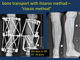 Bone Transfer Post-Traumatic Tibial Defects Treated by the Ilizarov Method | PPTX