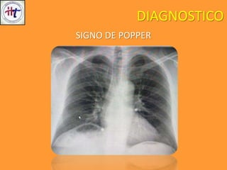 DIAGNOSTICO
SIGNO DE POPPER
 