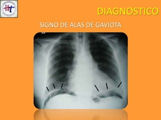 DIAGNOSTICO
SIGNO DE ALAS DE GAVIOTA
 