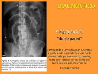DIAGNOSTICO
SIGNO RIGLE:
"doble pared"
corresponde a la visualizacion de ambas
superficies de la pared intestinal, por la
presencia de gas en contacto con ellas,
tanto en el interior del asa como por
fuera de ésta, por presencia de
neumoperitoneo
 