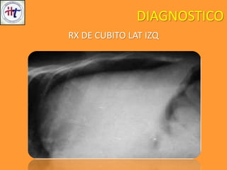 DIAGNOSTICO
RX DE CUBITO LAT IZQ
 