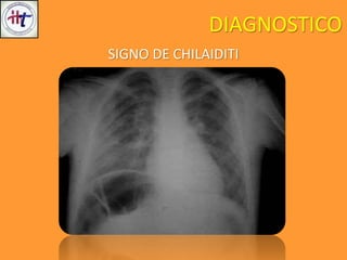 DIAGNOSTICO
SIGNO DE CHILAIDITI
 