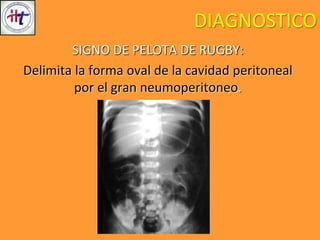 DIAGNOSTICO
SIGNO DE PELOTA DE RUGBY:
Delimita la forma oval de la cavidad peritoneal
por el gran neumoperitoneo.
 