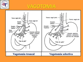 Vagotomía troncal
VAGOTOMIA
Vagotomía selectiva
 