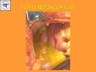 POSTENDOSCOPICAS
 