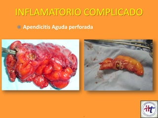 .
 Apendicitis Aguda perforada
INFLAMATORIO COMPLICADO
 