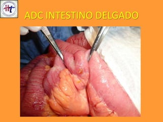 ADC INTESTINO DELGADO
 