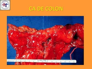 CA DE COLON
 
